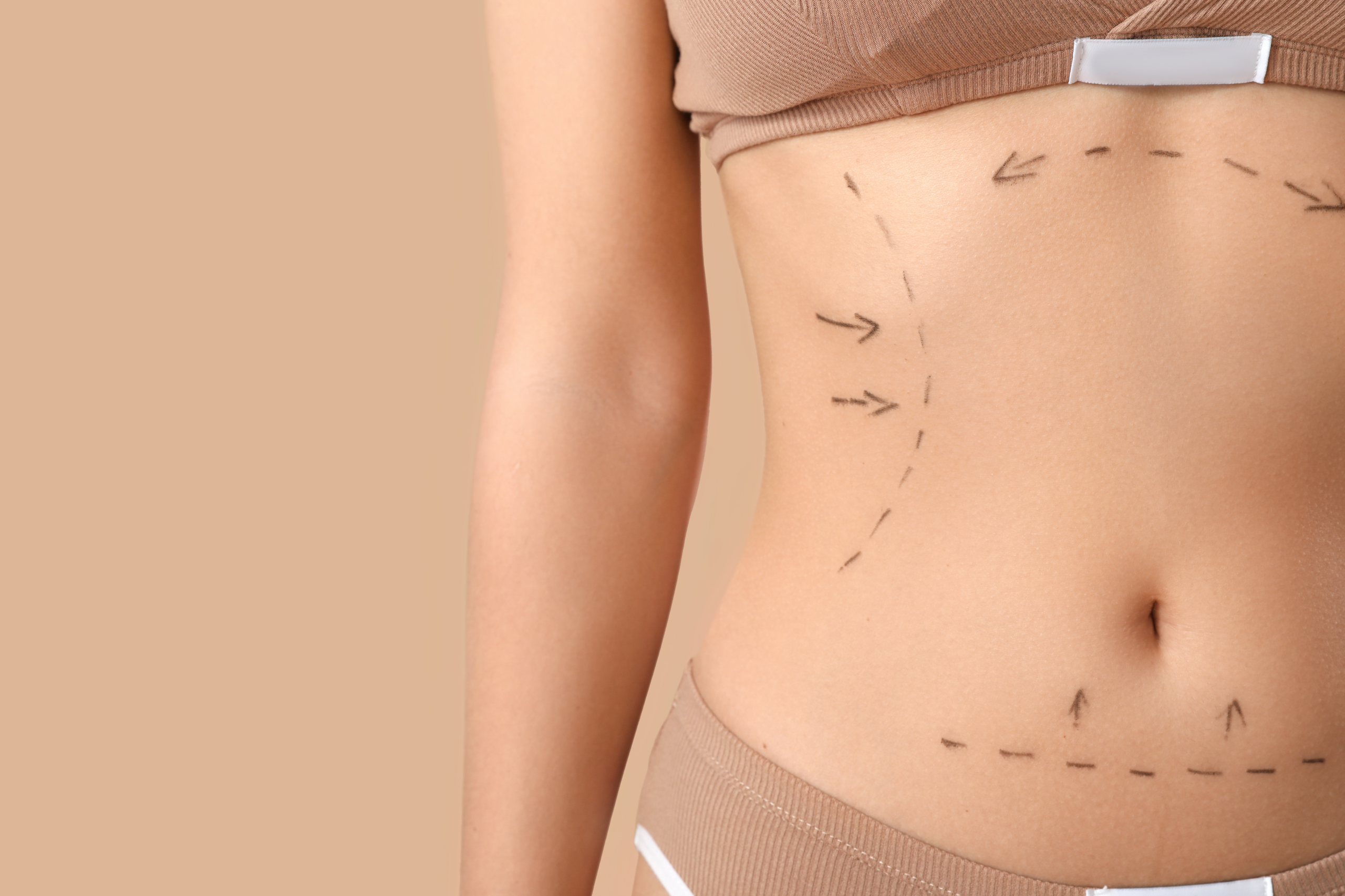 Are Aesthetic Surgeries Necessary After Obesity Surgery?