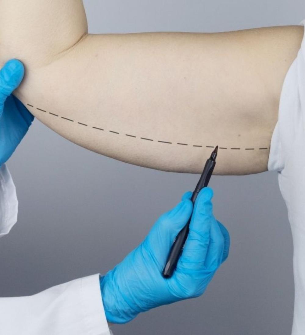 Brachioplasty (Arm Lift)