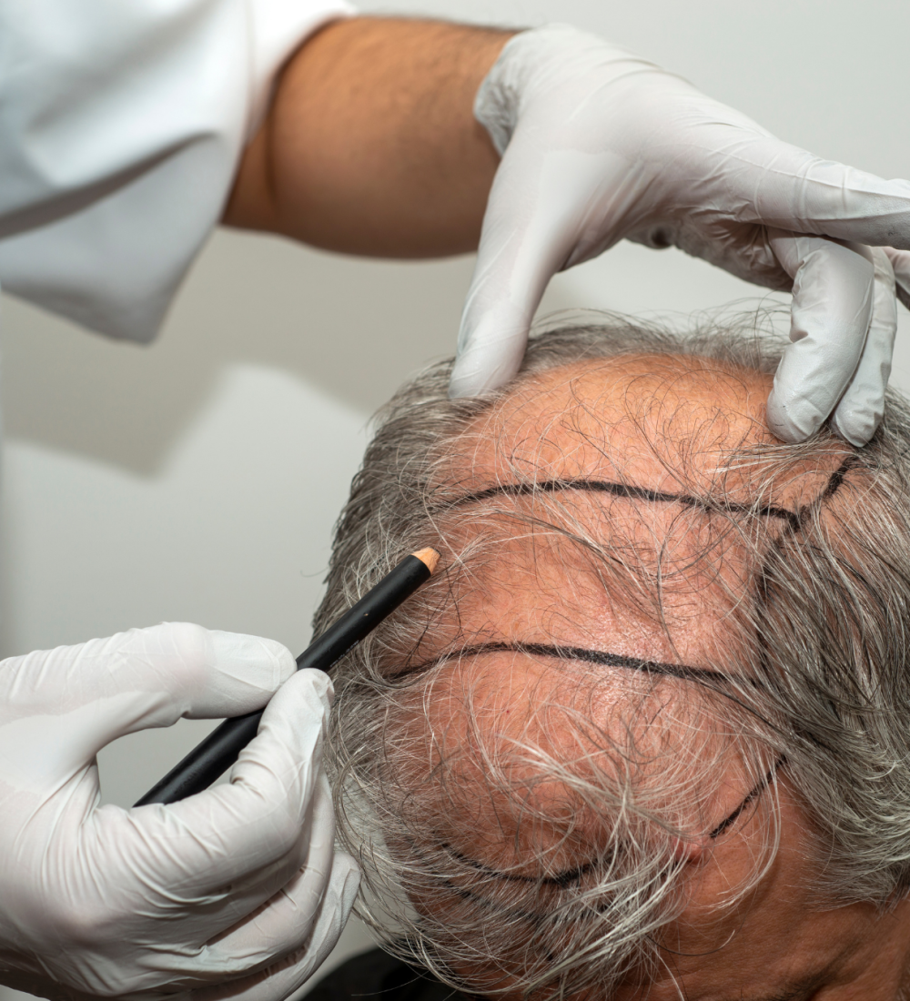 Hair Transplant (1)
