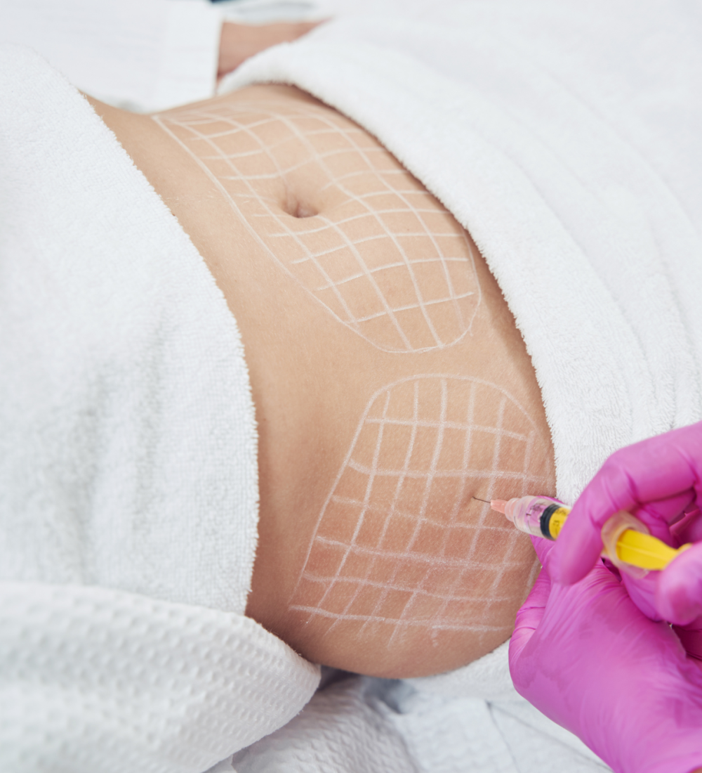 Liposuction